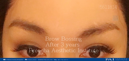 brow bossing after surgery best cosmetic and facial feminization surgery bangkok thailand