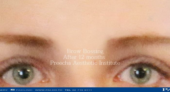 brow bossing after surgery by dr.burin, dr.sutin, dr.preecha bangkok thailand preecha aesthetic