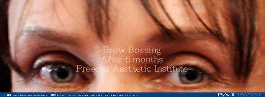 brow bossing after surgery facial feminization surgery