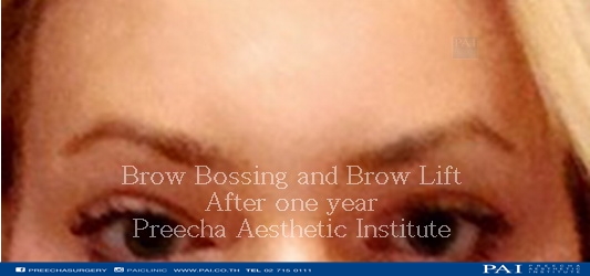 brow bossing and brow lift after facial feminization surgery thailand