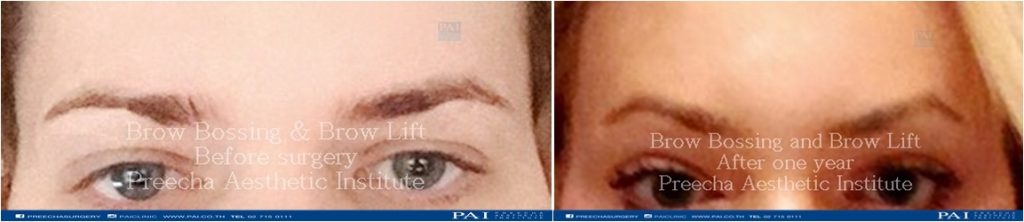 brow bossing and brow lift before and after facial feminization surgery thailand preecha aesthetic institute