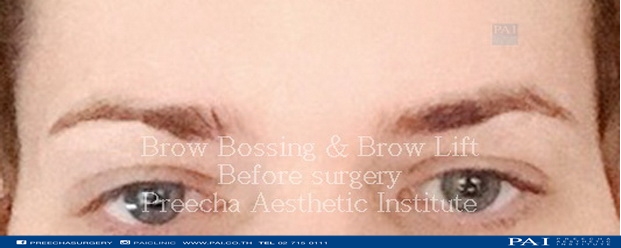 brow bossing and brow lift before facial feminization surgery thailand