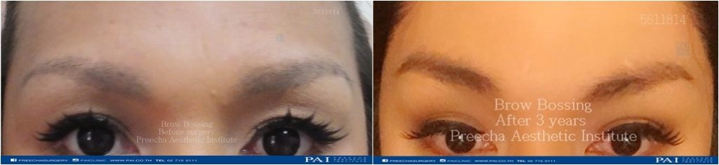 brow bossing before and after surgery best cosmetic and facial feminization surgery bangkok thailand