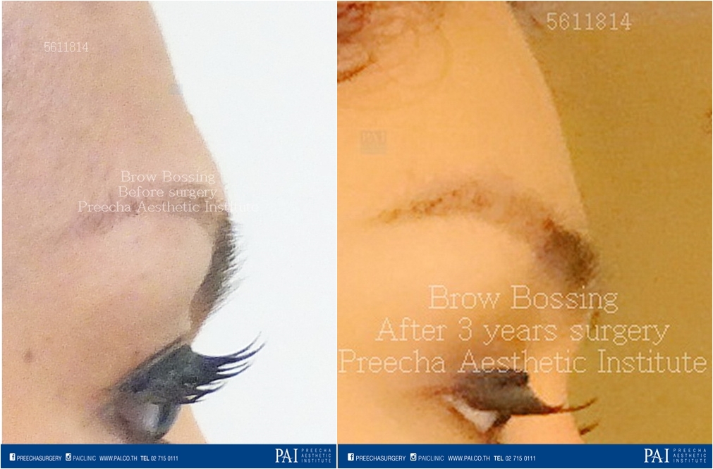 brow bossing before and after surgery best cosmetic and facial feminization surgery bangkok thailand Preecha Aesthetic institute