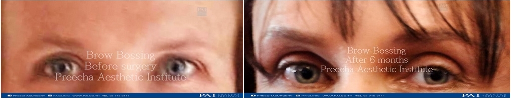 brow bossing before and after surgery facial feminization surgery