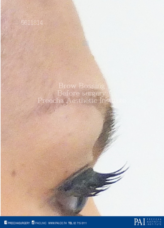 brow bossing before surgery best cosmetic and facial feminization surgery bangkok thailand Preecha Aesthetic