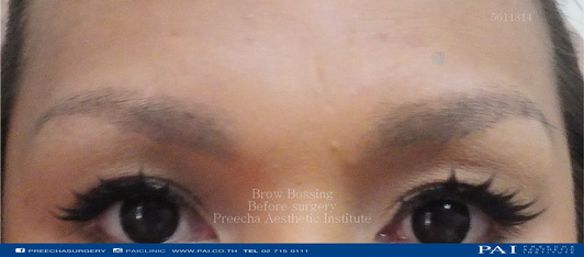brow bossing before surgery best cosmetic and facial feminization surgery bangkok thailand