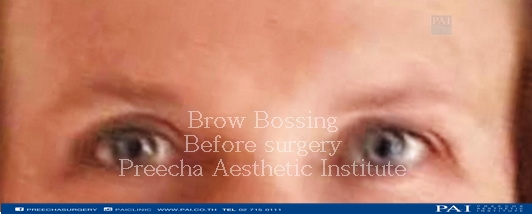 brow bossing before surgery facial feminization surgery