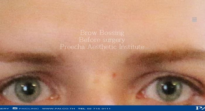 brow bossing before surgery preecha aesthetic institute bangkok
