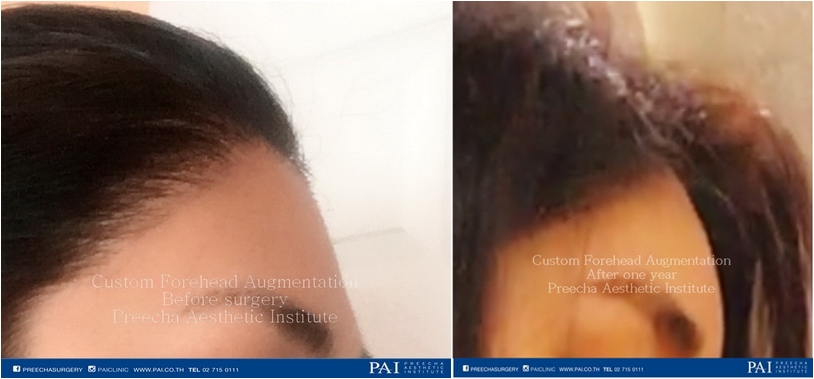 custom forehead augmentation pre operation post op fully recovery