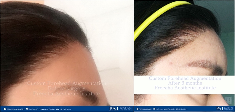 custom forehead augmentation pre operation post op