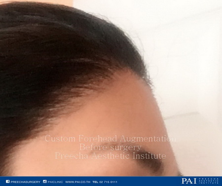 custom forehead augmentation pre operation