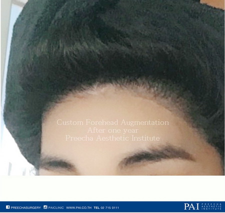 custom forehead implant post operation
