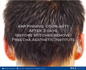 ear correction after 3 days surgery l Preecha Aesthetic Institute