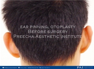 ear correction before surgery l Preecha Aesthetic Institute