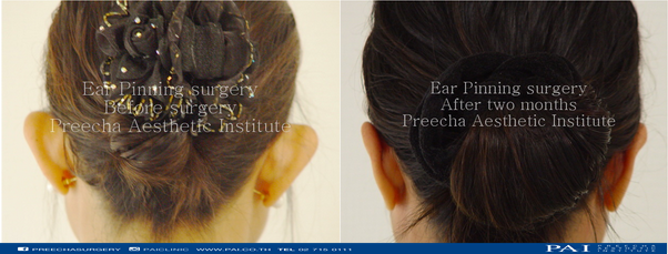 ear correction ear pinning before and after l preecha aesthetic institute