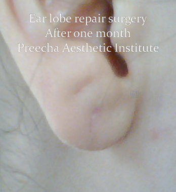 ear lobe repair surgery after one month