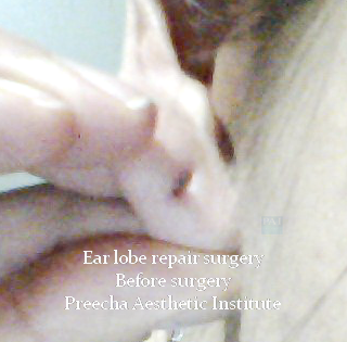 ear lobe repair surgery before surgery