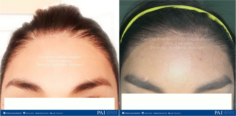 forehead custom implant before and after surgery
