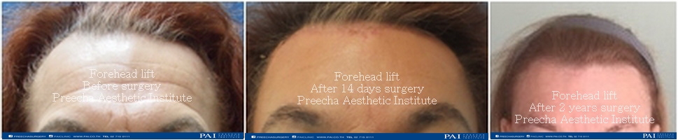 forehead lift before and after l preecha aesthetic institute