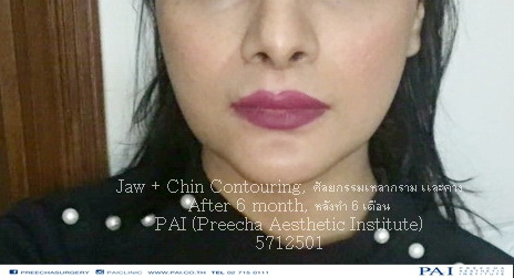 jaw contouring after surgery l preecha aesthetic institute bangkok