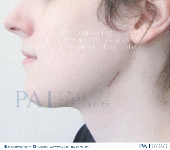 jaw contouring after two month surgery l preecha aesthetic institute bangkok thailand