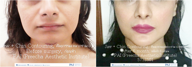 jaw contouring before and after 6 month surgery preecha aesthetic institute