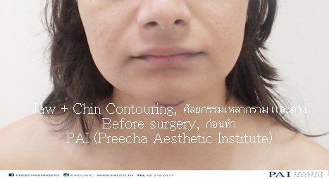 jaw contouring before surgery l preecha aesthetic institute bangkok