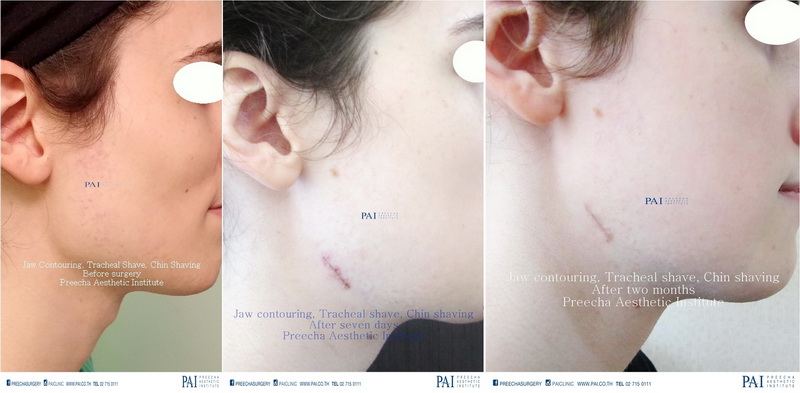 jaw contouring, tracheal shave, chin shaving, facial feminization surgery before and after l preecha aesthetic institute bangkok thailand