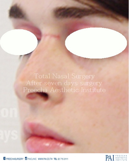 nose reconstruction facial feminization surgery post op seven days
