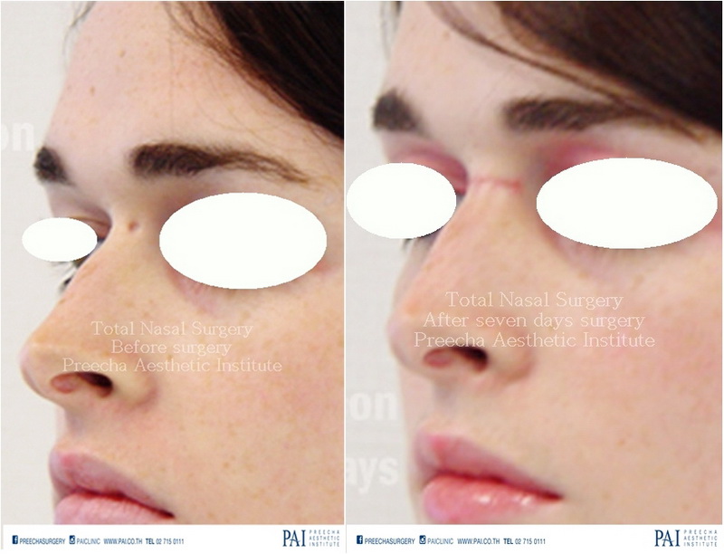 nose reconstruction facial feminization surgery pre op post op seven days