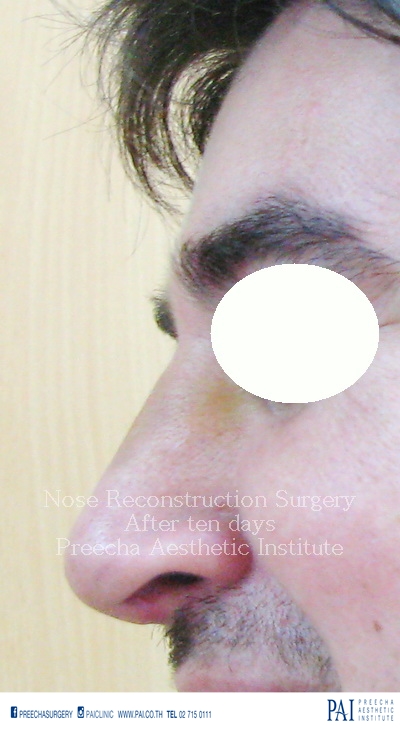 nose reconstruction surgery for hump removal after surgery