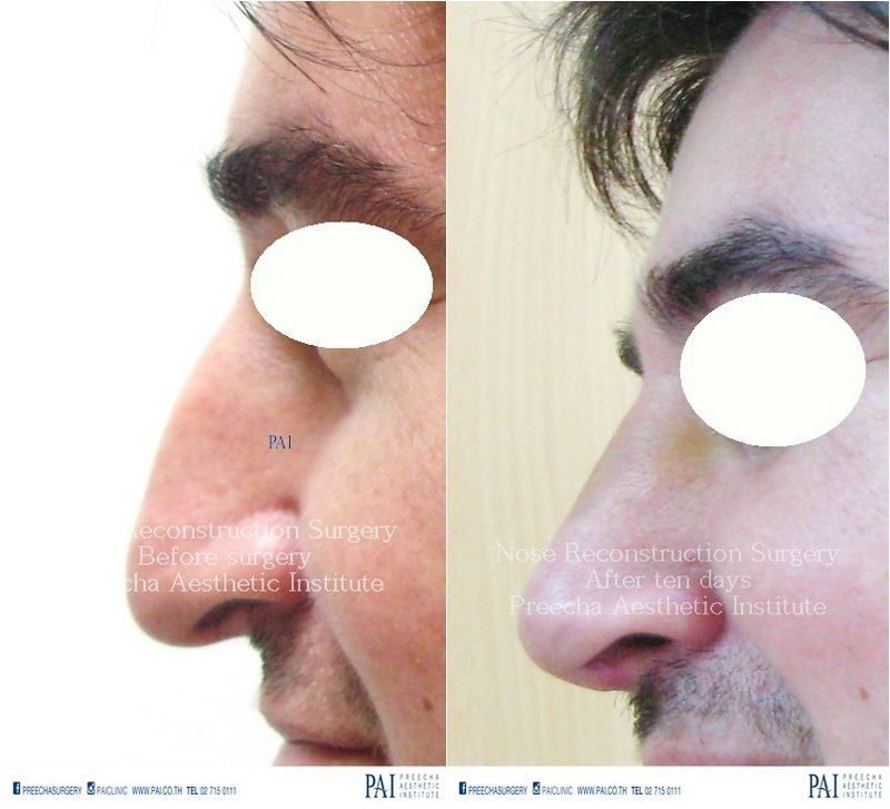 nose reconstruction surgery for hump removal before surgery after