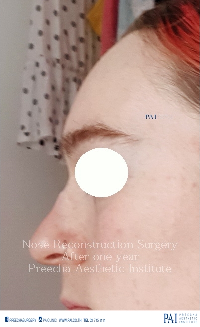 nose reconstruction surgery for transwomen after one year