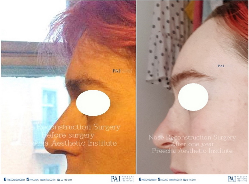 nose reconstruction surgery for transwomen before surgegy after surgery