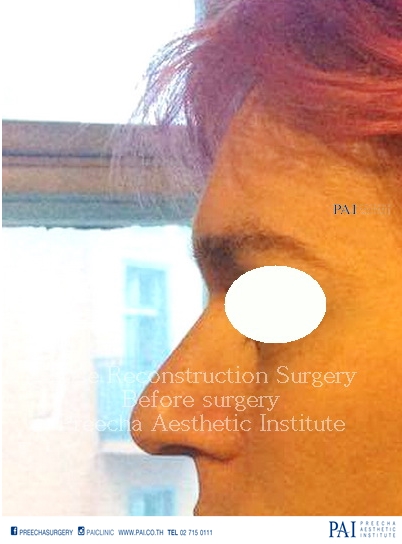 nose reconstruction surgery for transwomen before surgegy