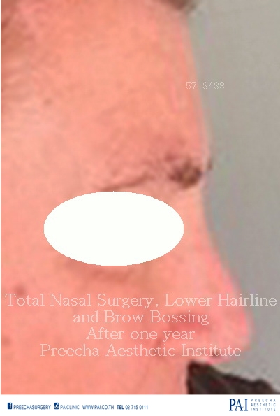 nose reduction total nasal surgery, lower hairline, brow bossing facial feminization surgery after one year surgery