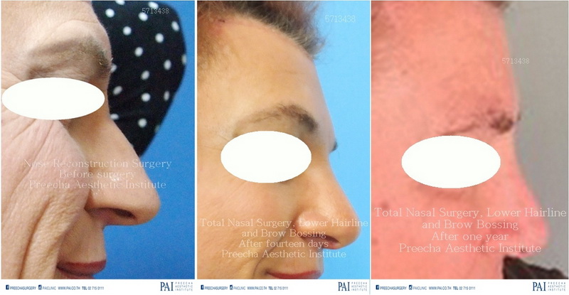nose reduction total nasal surgery, lower hairline, brow bossing facial feminization surgery before and after surgery