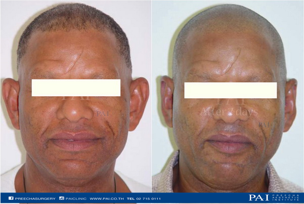 otoplasty before and after surgery l preecha aesthetic institute