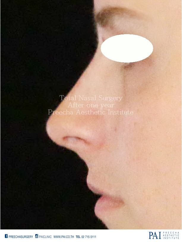 total nasal surgery after surgery facial feminization surgery