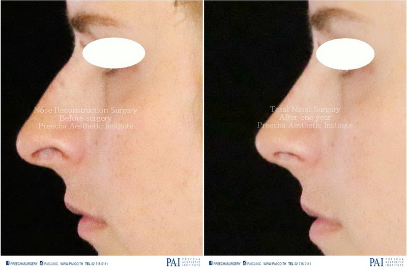 total nasal surgery before and after surgery facial feminization surgery