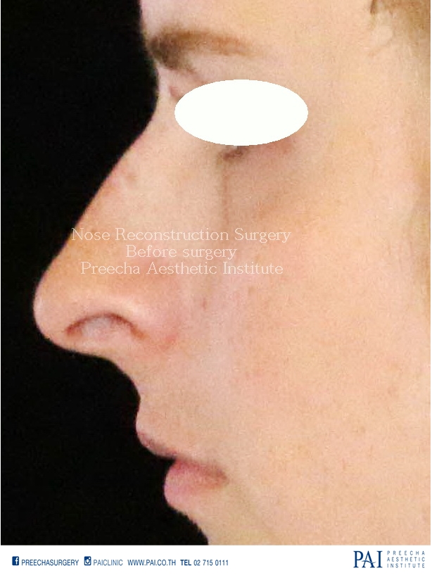 total nasal surgery before surgery facial feminization surgery