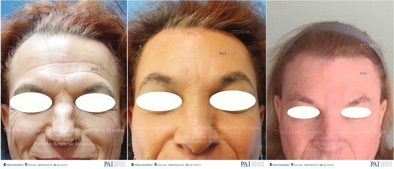 total nasal surgery, brow bossing, lower hairline surgery facial feminization surgery FFS, before surgery after surgery
