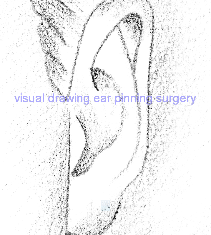visual drawing ear pinning surgery