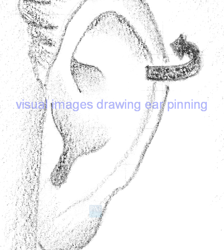 visual drawing ear pinning surgical